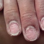 Агрессивное механической воздействие на ногти ухудшает их состояние