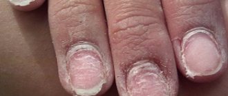 Агрессивное механической воздействие на ногти ухудшает их состояние