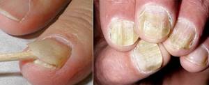атрофический микоз ногтей