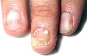 формы грибка ногтей