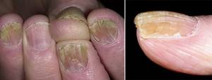 гипертрофический микоз ногтей