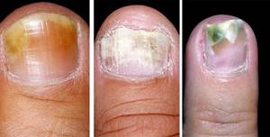 изменение цвета ногтей при грибковом поражении
