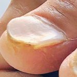 Койлонихия или ложкообразные ногти фото