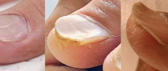 Койлонихия или ложкообразные ногти фото