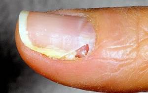 латеральное грибковое поражение ногтя