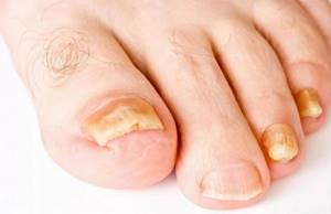 Лечение и профилактика трещин на ногте большого пальца ноги
