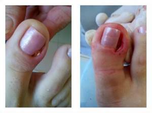 Лечение ногтя, до и после