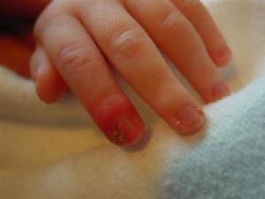На фото грибок ногтей у детей