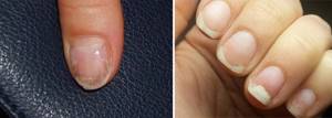 На фото первые признаки грибкового поражения ногтей