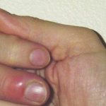 Нарывает палец на руке возле ногтя (паронихия) фото
