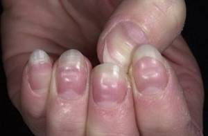 неровные ногти