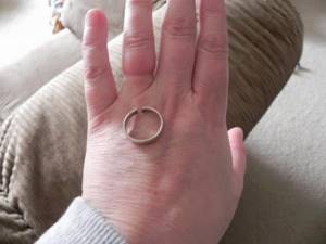 Опух палец сняли кольцо