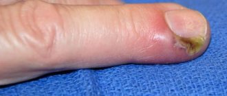 Панариций пальца