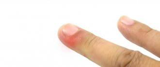 Subcutaneous panaritium: photos, causes and symptoms, treatment methods