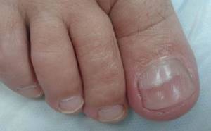 Почему появляются бороздки на ногтях