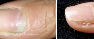 признаки грибкового поражения ногтей