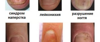 Псориаз ногтей: как привести ногти в порядок? фото