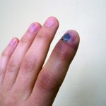 сильный ушиб пальца