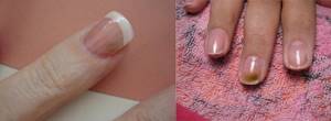 Симптомы и признаки грибка ногтей на руках