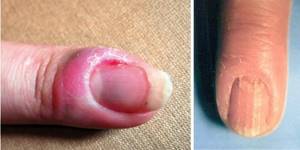 симптомы и признаки начальной стадии грибка ногтей