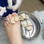 Удаления ногтя на ноге хирургом
