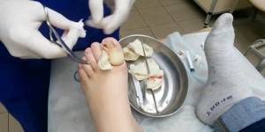 Удаления ногтя на ноге хирургом