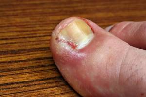 Виды и лечение панариция на пальце ноги